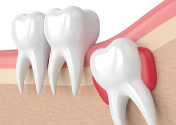 Wisdom Tooth Removal in uppal