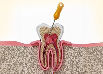 Root canal treatment in uppal