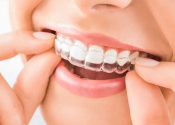 Aligners & Braces in uppal 