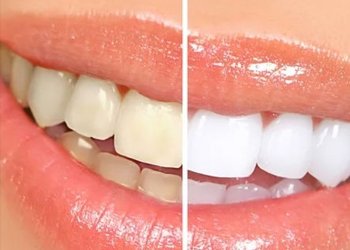 Teeth Whitening