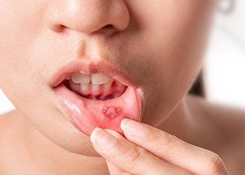 Mouth Ulcers