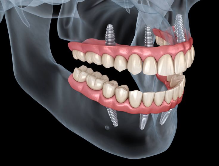 Dental implants in uppal