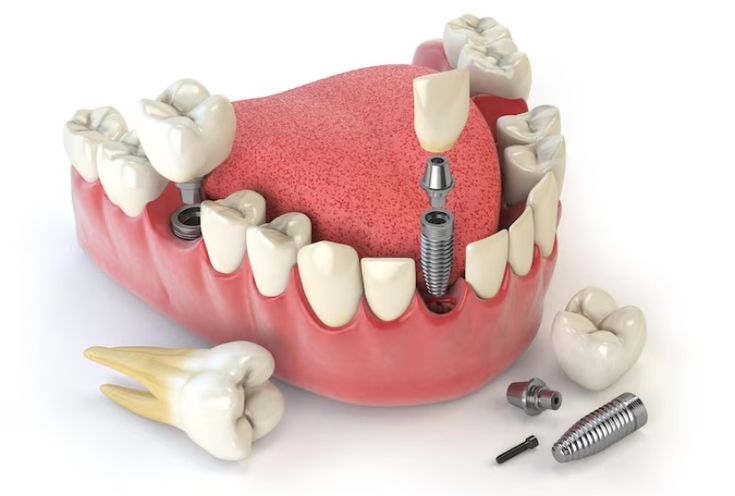 Dental implants in uppal
