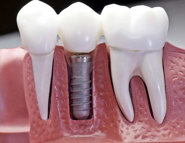 Dental implants in uppal