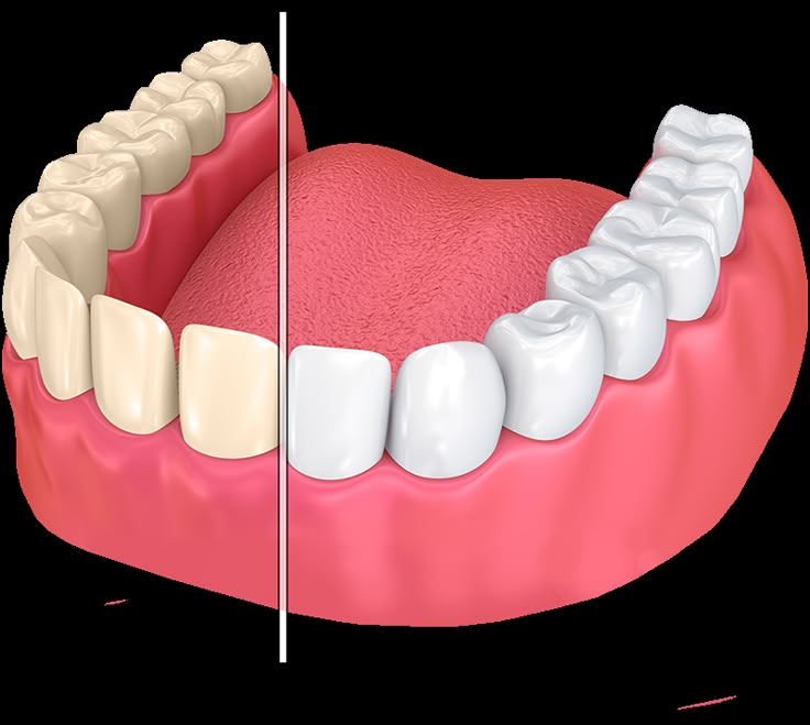 Teeth Whitening: A Complete Guide to a Brighter