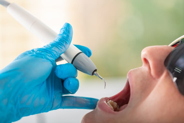 Teeth Cleaning in Uppal