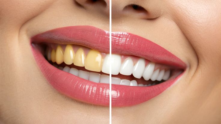 Teeth Whitening: A Complete Guide to a Brighter
