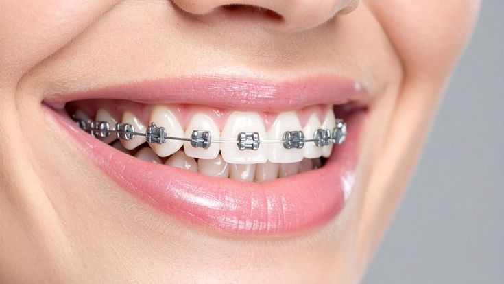 braces cost in Hyderabad